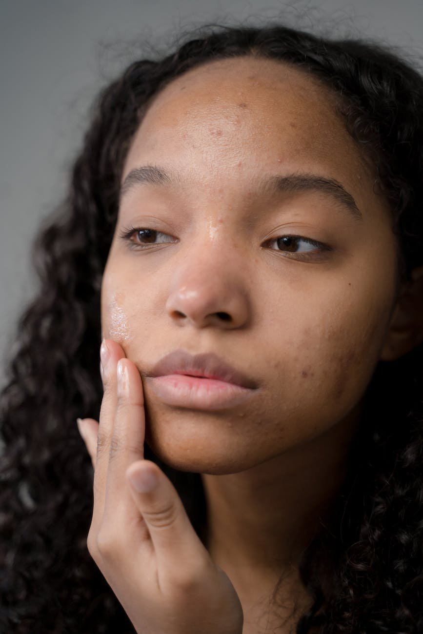 L’acné de l’adolescent et son impact psychologique